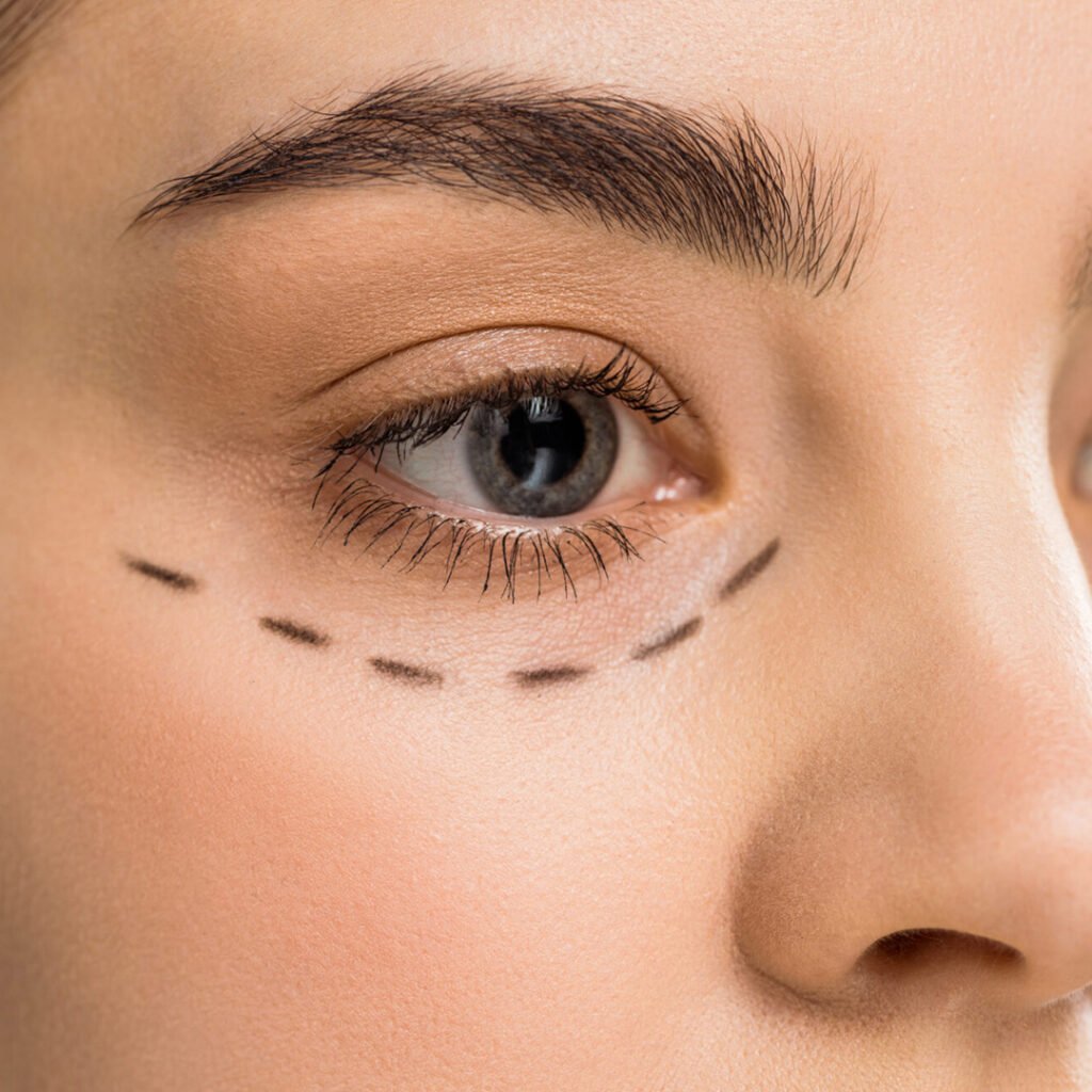 Blepharoplasty in Indore illustrating upper and lower eyelid correction procedure