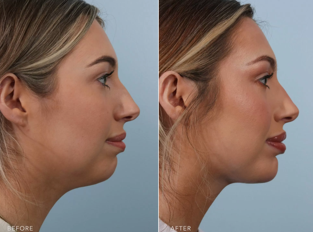 Chin augmentation in Indore showing before and after facial profile enhancement