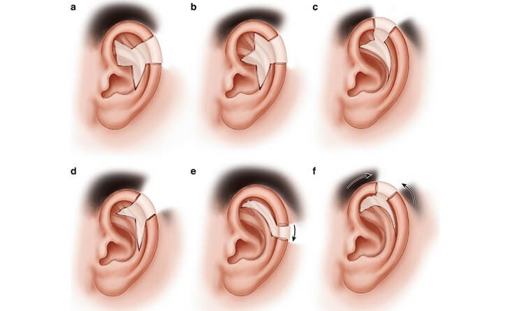 Ear reconstruction in Indore illustrating surgical repair and evaluation of ear structure