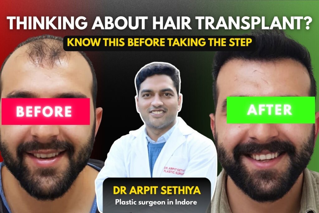 Hair transplant in Indore showing before and after results under the care of a plastic surgeon