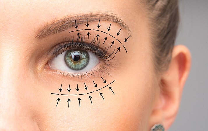 Blepharoplasty in Indore illustrating upper and lower eyelid correction procedure