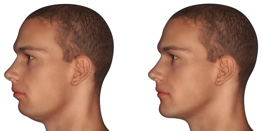 Chin augmentation in Indore showing before and after facial profile enhancement