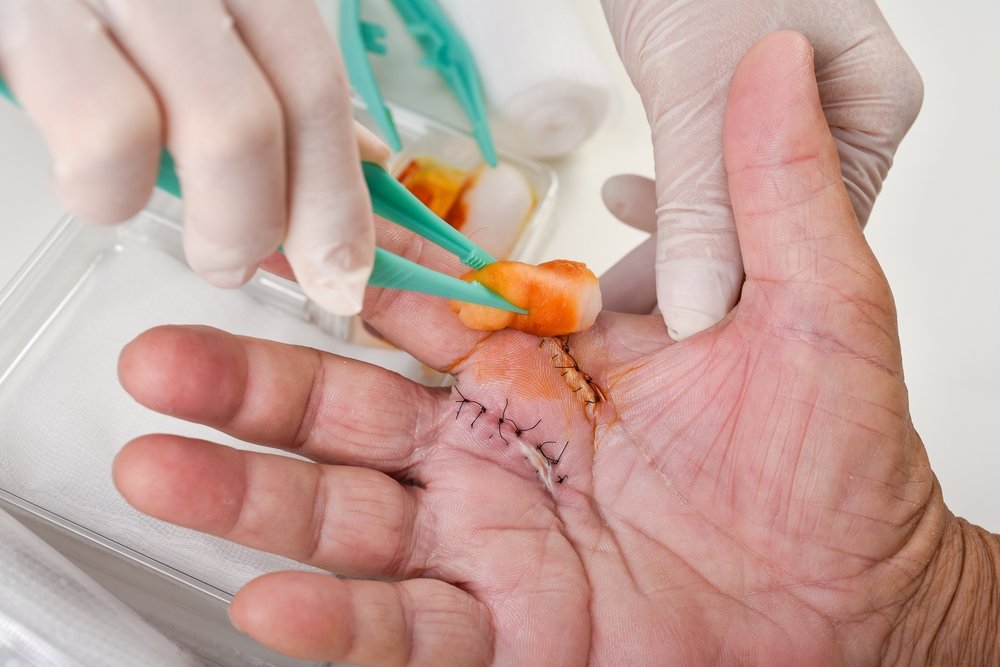Hand surgery in Indore showing precise suturing and post-operative wound care by an experienced plastic surgeon