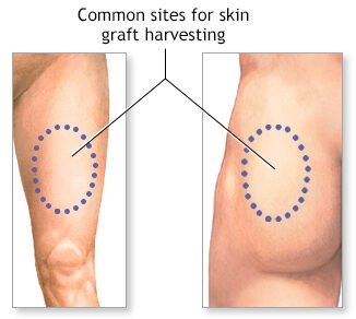 Skin grafting surgery in Indore showing common donor sites used for reconstructive treatment