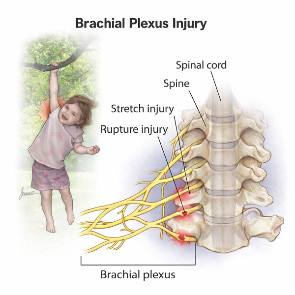 Brachial plexus surgery in Indore showing nerve injury types and reconstruction anatomy