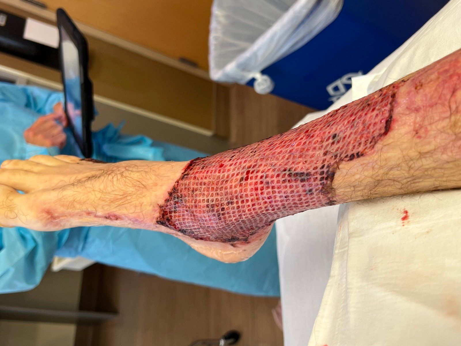 Skin grafting surgery in Indore showing common donor sites used for reconstructive treatment