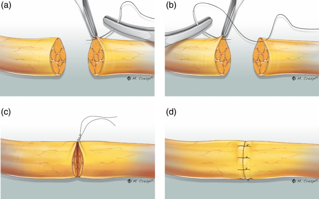 Nerve reconstruction in Indore showing step-by-step repair of an injured nerve using microsurgical technique